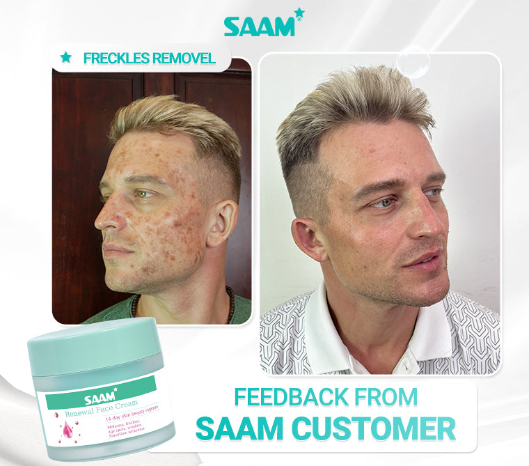 SAAM Renewal Face Cream is SAAM exclusive product, specialized in treating melasma, freckles, age spots, and dark spots.