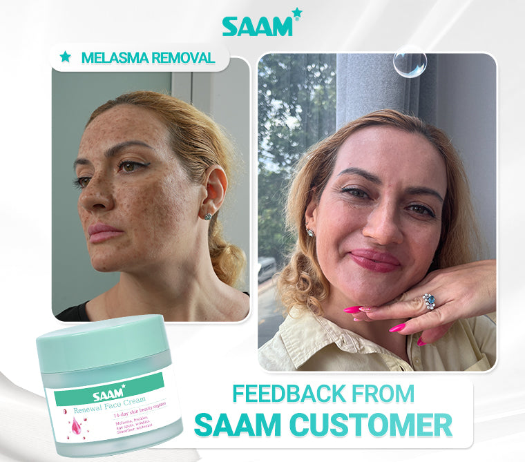 SAAM Renewal Face Cream is SAAM exclusive product, specialized in treating melasma, freckles, age spots, and dark spots.