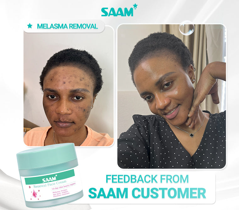 SAAM Renewal Face Cream is SAAM exclusive product, specialized in treating melasma, freckles, age spots, and dark spots.