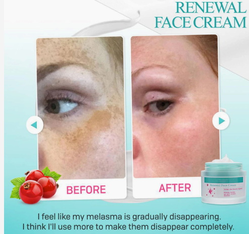 1pcRenewal FaceCream For Melasma And Freckles Cosmetics Frost Dark Wrinkle Face 1pc 1, 50g