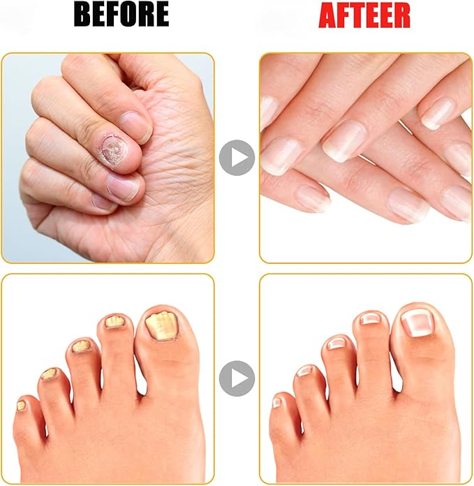 Ingrown Toenail Care Kit, Extra Strong Fungal Solution & Professional Removal Tool for Thick Toenails