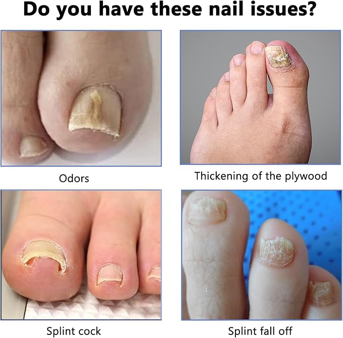 Ingrown Toenail Care Kit, Extra Strong Fungal Solution & Professional Removal Tool for Thick Toenails