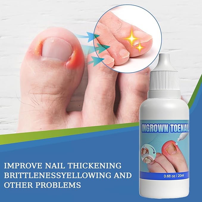 Ingrown Toenail Care Kit, Extra Strong Fungal Solution & Professional Removal Tool for Thick Toenails