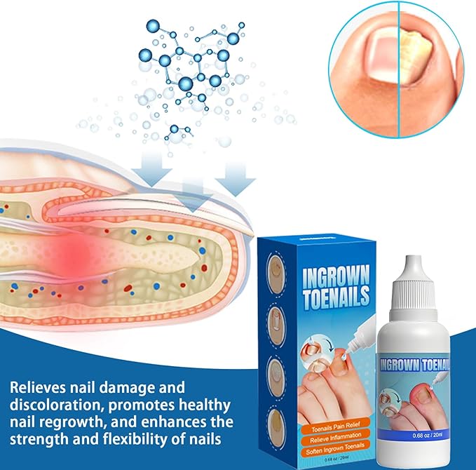 Ingrown Toenail Care Kit, Extra Strong Fungal Solution & Professional Removal Tool for Thick Toenails