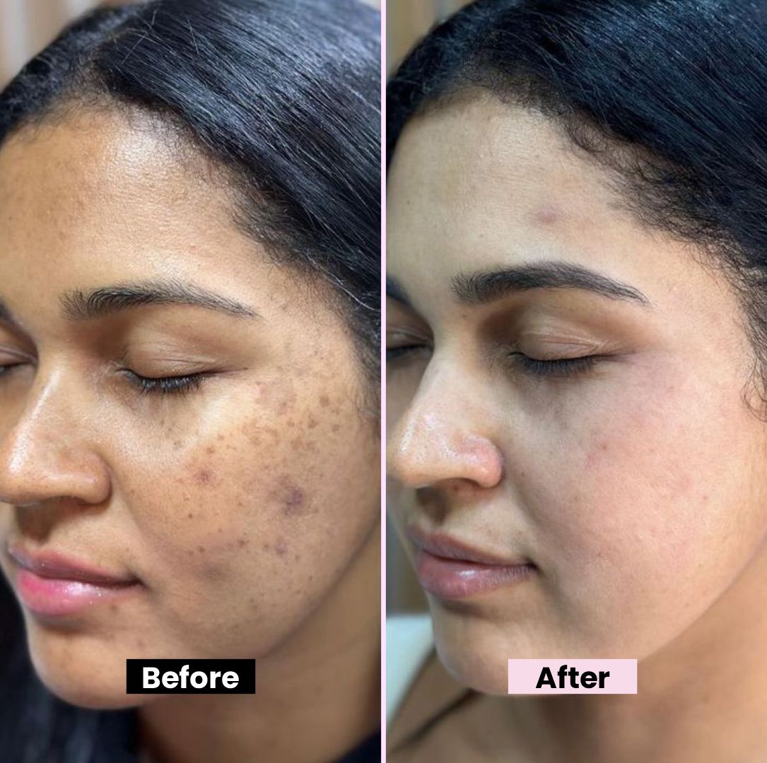Argussy Acne Solution Emergency spot Remover cream Acne Free Within 2 days 7 gm